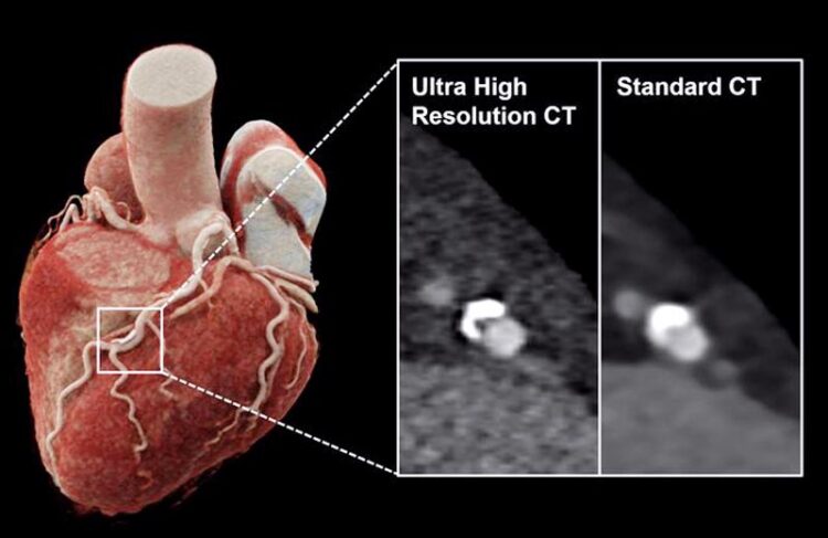 Innovative-Computertomographie-verbessert-Beurteilung-der-koronaren-Herzkrankheit